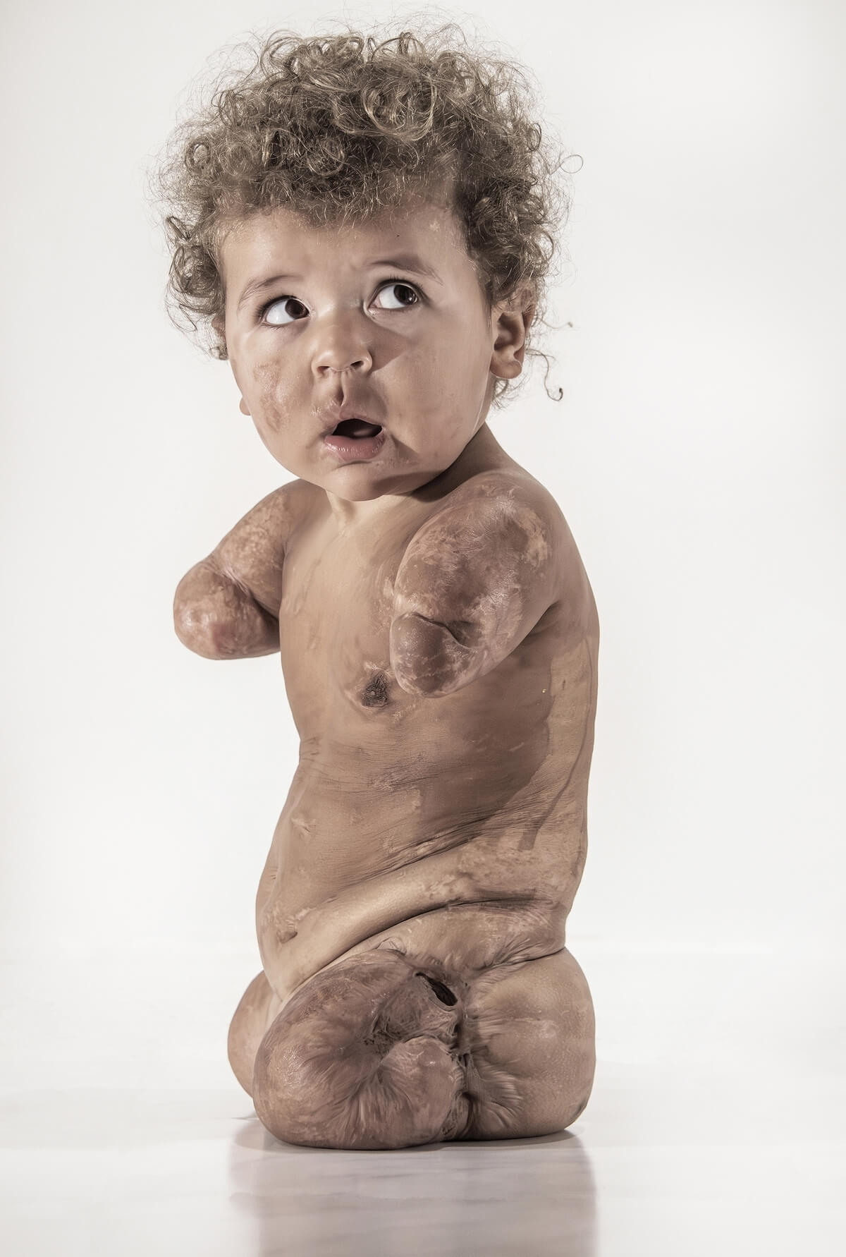"Tobias Survives Meningococcal Disease" by Brian Cassey